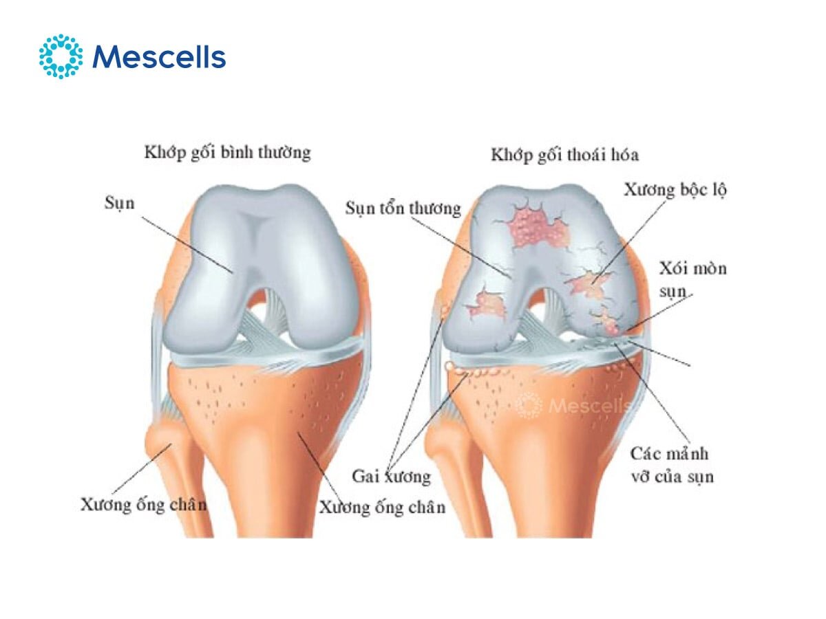 tiem-te-bao-goc-vao-khop-goi-1