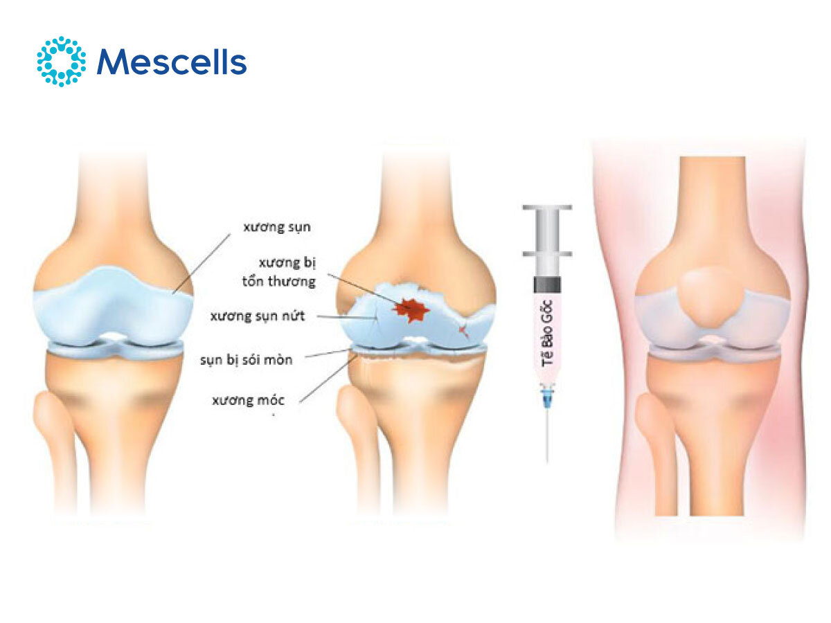tiem-te-bao-goc-vao-khop-goi-3